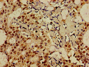 FOXA1 Antibody - Immunohistochemistry image of paraffin-embedded human breast cancer at a dilution of 1:100