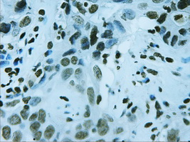 FOXA2 Antibody - IHC of paraffin-embedded Carcinoma of liver using anti-FOXA2 mouse monoclonal antibody.