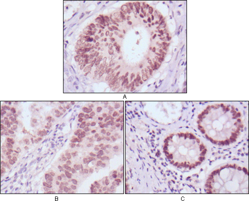 FOXA2 Antibody - IHC of paraffin-embedded human colon cancer (A), gastric cancer (B) and rectal cancer (C) tissues using FOXA2 mouse monoclonal antibody with DAB staining.