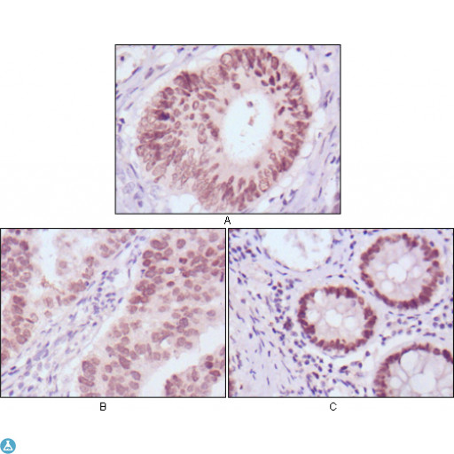 FOXA2 Antibody - Immunohistochemistry (IHC) analysis of paraffin-embedded Human Colon cancer (A), gastric cancer (B) and rectal cancer (C) tissues with DAB staining using FoxA2 Monoclonal Antibody.