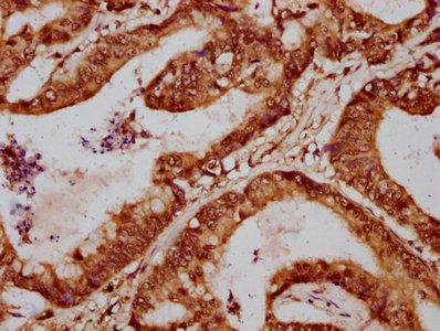FOXA3 Antibody - Immunohistochemistry Dilution at 1:700 and staining in paraffin-embedded human colon cancer performed on a Leica BondTM system. After dewaxing and hydration, antigen retrieval was mediated by high pressure in a citrate buffer (pH 6.0). Section was blocked with 10% normal Goat serum 30min at RT. Then primary antibody (1% BSA) was incubated at 4°C overnight. The primary is detected by a biotinylated Secondary antibody and visualized using an HRP conjugated SP system.