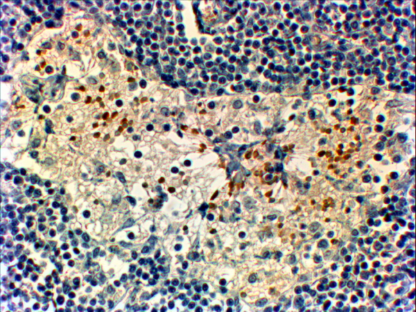FOXC2 Antibody - FOXC2 Antibody (2µg/ml) staining of paraffin embedded Human Breast Cancer. Steamed antigen retrieval with Tris/EDTA buffer Ph 9, HRP-staining. This data is from a previous batch, not on sale.