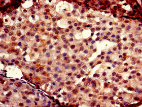 FOXC2 Antibody - Immunohistochemistry of paraffin-embedded human breast cancer using FOXC2 Antibody at dilution of 1:100
