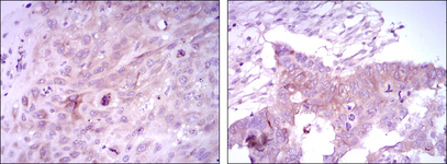 FOXD3 Antibody - IHC of paraffin-embedded lung cancer tissues (left) and ovarian cancer tissues (right) using FOXD3 mouse monoclonal antibody with DAB staining.