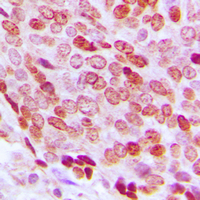 FOXD3 Antibody - Immunohistochemical analysis of FOXD3 staining in human prostate cancer formalin fixed paraffin embedded tissue section. The section was pre-treated using heat mediated antigen retrieval with sodium citrate buffer (pH 6.0). The section was then incubated with the antibody at room temperature and detected using an HRP conjugated compact polymer system. DAB was used as the chromogen. The section was then counterstained with hematoxylin and mounted with DPX.