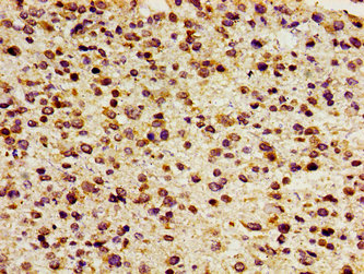 FOXD3 Antibody - Immunohistochemistry image of paraffin-embedded human glioma cancer at a dilution of 1:100