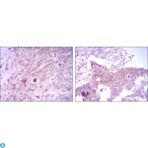 FOXD3 Antibody - Immunohistochemistry (IHC) analysis of paraffin-embedded Lung Cancer Tissues (left) and ovarian cancer tissues (right) with DAB staining using FoxD3 Monoclonal Antibody.