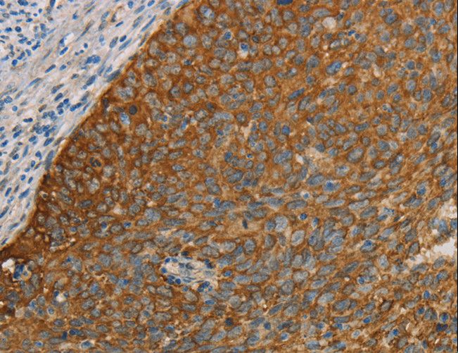 FOXF2 Antibody - Immunohistochemistry of paraffin-embedded Human cervical cancer using FOXF2 Polyclonal Antibody at dilution of 1:30.