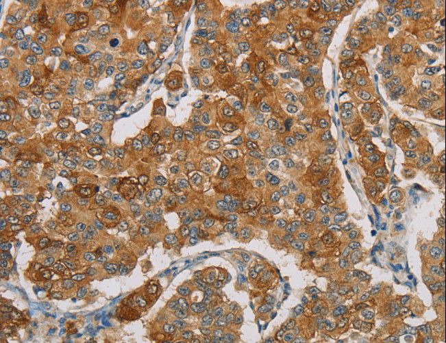 FOXF2 Antibody - Immunohistochemistry of paraffin-embedded Human breast cancer using FOXF2 Polyclonal Antibody at dilution of 1:30.