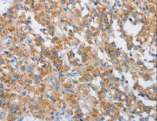 FOXF2 Antibody - Immunohistochemistry of paraffin-embedded Human thyroid cancer using FOXF2 Polyclonal Antibody at dilution of 1:30.