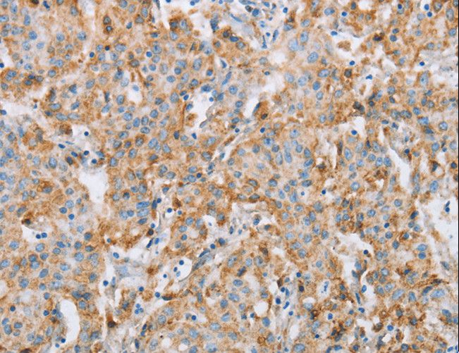 FOXF2 Antibody - Immunohistochemistry of paraffin-embedded Human gastric cancer using FOXF2 Polyclonal Antibody at dilution of 1:30.