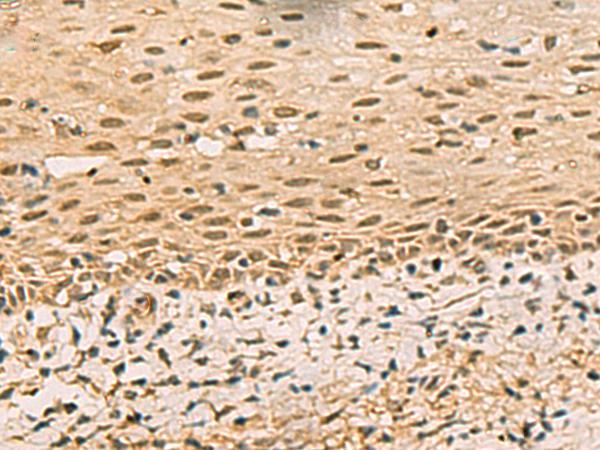 FOXH1 Antibody - Immunohistochemistry of paraffin-embedded Human cervical cancer tissue  using FOXH1 Polyclonal Antibody at dilution of 1:40(×200)