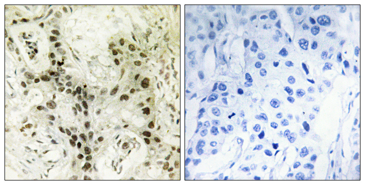 FOXI1 Antibody - Immunohistochemistry analysis of paraffin-embedded human breast carcinoma tissue, using FOXI1 Antibody. The picture on the right is blocked with the synthesized peptide.