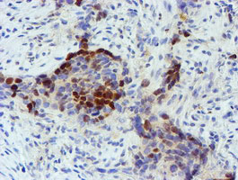 FOXI1 Antibody - IHC of paraffin-embedded Carcinoma of Human lung tissue using anti-FOXI1 mouse monoclonal antibody.