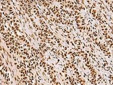 FOXI1 Antibody - Immunohistochemistry of paraffin-embedded Human ovarian cancer tissue  using FOXI1 Polyclonal Antibody at dilution of 1:55(×200)