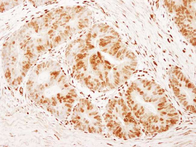 FOXK1 / MNF Antibody - Detection of Human FOXK1 by Immunohistochemistry. Sample: FFPE section of human colon carcinoma. Antibody: Affinity purified rabbit anti-FOXK1 used at a dilution of 1:1000 (1 ug/ml). Detection: DAB.
