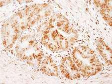 FOXK1 / MNF Antibody - Detection of Human FOXK1 by Immunohistochemistry. Sample: FFPE section of human colon carcinoma. Antibody: Affinity purified rabbit anti-FOXK1 used at a dilution of 1:1000 (1 ug/ml). Detection: DAB.