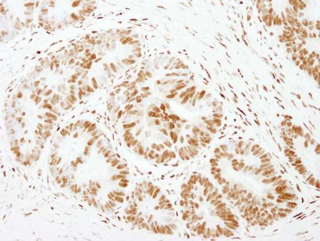 FOXK1 / MNF Antibody - Detection of Human FOXK1 by Immunohistochemistry. Sample: FFPE section of human colon carcinoma. Antibody: Affinity purified rabbit anti-FOXK1 used at a dilution of 1:500.