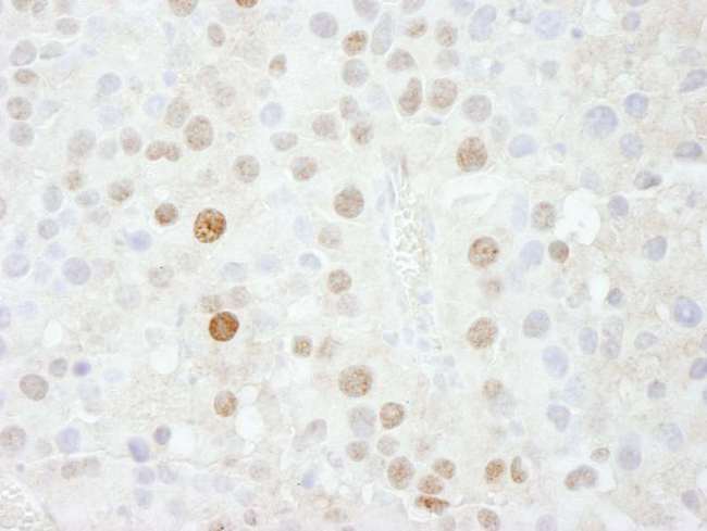 FOXK1 / MNF Antibody - Detection of Mouse FOXK1 by Immunohistochemistry. Sample: FFPE section of mouse renal cell carcinoma. Antibody: Affinity purified rabbit anti-FOXK1 used at a dilution of 1:500.