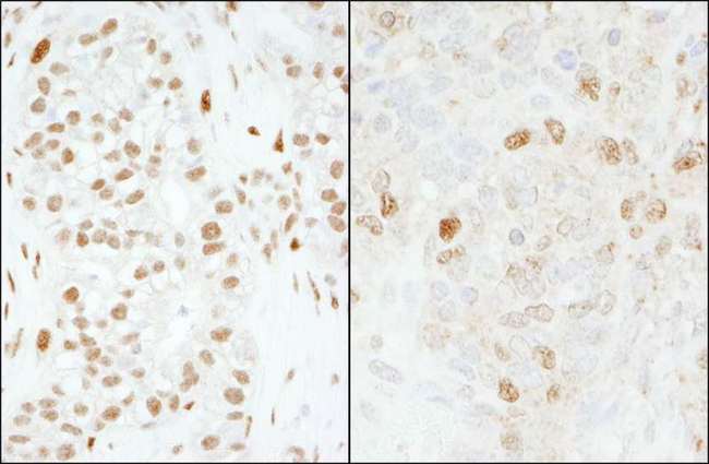 FOXK1 / MNF Antibody - Detection of Human and Mouse FOXK1 by Immunohistochemistry. Sample: FFPE section of human breast carcinoma (left) and mouse teratoma (right). Antibody: Affinity purified rabbit anti-FOXK1 used at a dilution of 1:1000 (0.2 ug/ml) and 1:200 (1 ug/ml). Detection: DAB.
