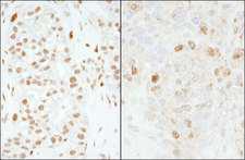 FOXK1 / MNF Antibody - Detection of Human and Mouse FOXK1 by Immunohistochemistry. Sample: FFPE section of human breast carcinoma (left) and mouse teratoma (right). Antibody: Affinity purified rabbit anti-FOXK1 used at a dilution of 1:1000 (0.2 ug/ml) and 1:200 (1 ug/ml). Detection: DAB.