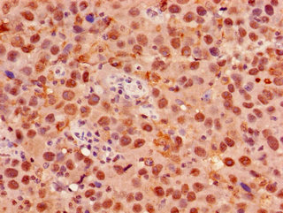 FOXK1 / MNF Antibody - Immunohistochemistry of paraffin-embedded human pancreatic cancer using FOXK1 Antibody at dilution of 1:100