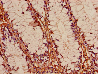 FOXK1 / MNF Antibody - Immunohistochemistry of paraffin-embedded human colon cancer using FOXK1 Antibody at dilution of 1:100