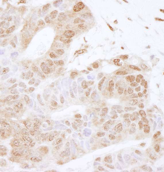 FOXK2 / ILF Antibody - Detection of Human FOXK2 by Immunohistochemistry. Sample: FFPE section of human ovarian carcinoma. Antibody: Affinity purified rabbit anti-FOXK2 used at a dilution of 1:200 (1 ug/ml). Detection: DAB.