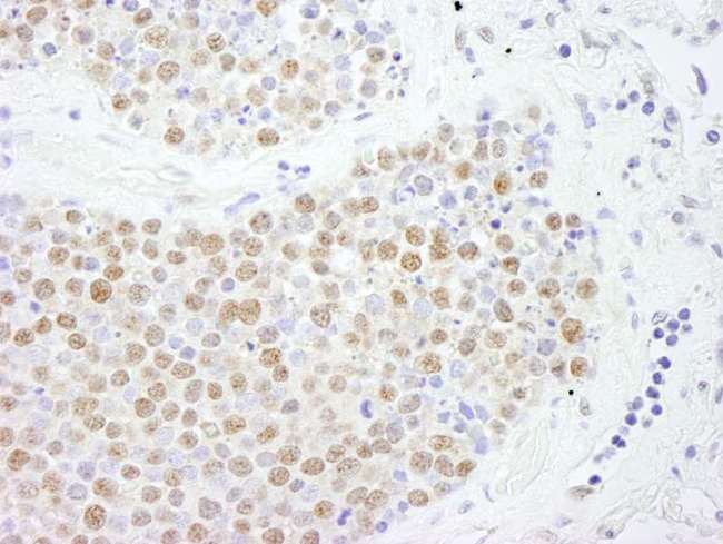 FOXK2 / ILF Antibody - Detection of Human FoxK2 by Immunohistochemistry. Sample: FFPE section of human small cell lung cancer. Antibody: Affinity purified rabbit anti-FoxK2 used at a dilution of 1:250.