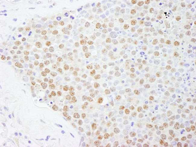 FOXK2 / ILF Antibody - Detection of Human FOXK2 by Immunohistochemistry. Sample: FFPE section of human small cell lung cancer. Antibody: Affinity purified rabbit anti-FOXK2 used at a dilution of 1:200 (1 ug/ml). Detection: DAB.