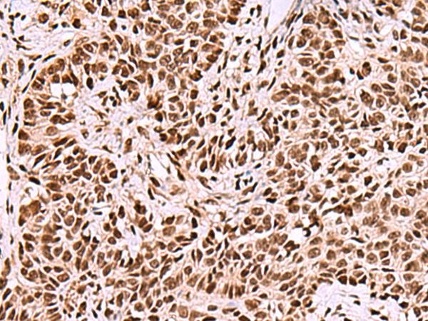 FOXK2 / ILF Antibody - Immunohistochemistry of paraffin-embedded Human ovarian cancer tissue  using FOXK2 Polyclonal Antibody at dilution of 1:50(×200)