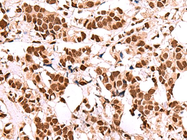 FOXK2 / ILF Antibody - Immunohistochemistry of paraffin-embedded Human breast cancer tissue  using FOXK2 Polyclonal Antibody at dilution of 1:60(×200)