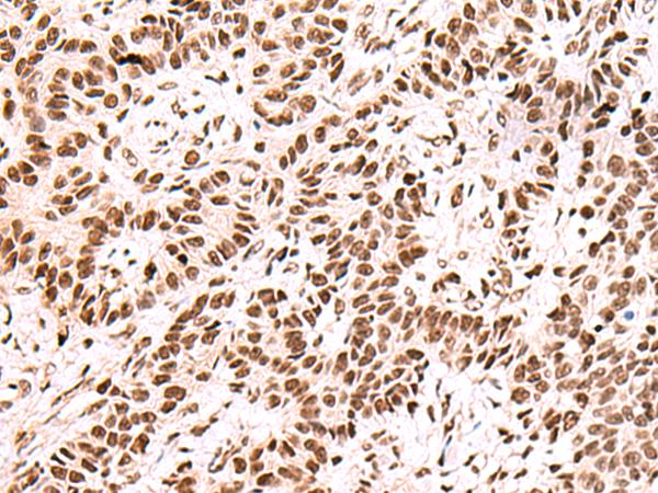 FOXK2 / ILF Antibody - Immunohistochemistry of paraffin-embedded Human ovarian cancer tissue  using FOXK2 Polyclonal Antibody at dilution of 1:60(×200)