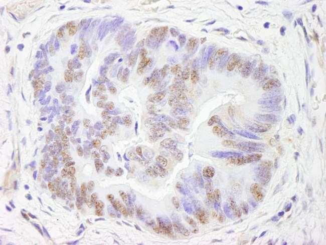 FOXM1 Antibody - Detection of Human FOXM1 by Immunohistochemistry. Sample: FFPE section of human colon carcinoma. Antibody: Affinity purified rabbit anti-FOXM1 used at a dilution of 1:1000 (1 ug/ml). Detection: DAB.