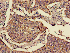 FOXN1 Antibody - Immunohistochemistry of paraffin-embedded human cervical cancer using FOXN1 Antibody at dilution of 1:100