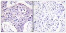 FOXO1+3+4 Antibody - Peptide - + Immunohistochemistry analysis of paraffin-embedded human breast carcinoma tissue using FOXO1/3/4-pan antibody.