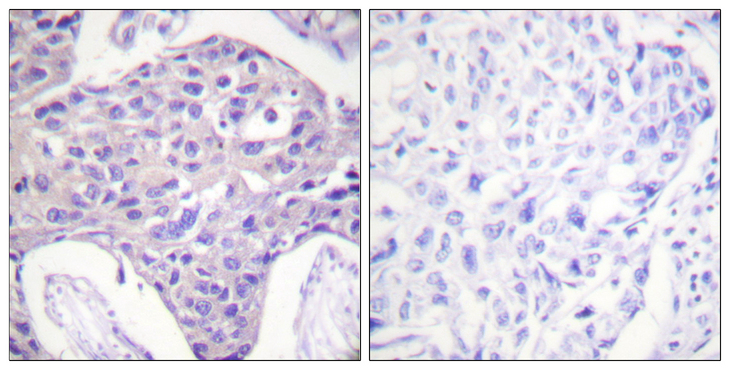 FOXO1+3+4 Antibody - Immunohistochemistry analysis of paraffin-embedded human breast carcinoma tissue, using FOXO1/3/4-pan Antibody. The picture on the right is blocked with the synthesized peptide.