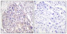 FOXO1+3+4 Antibody - Immunohistochemistry analysis of paraffin-embedded human breast carcinoma, using FOXO1/3/4-pan (Phospho-Thr24/32) Antibody. The picture on the right is blocked with the phospho peptide.