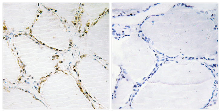 FOXO1 / FKHR Antibody - Immunohistochemistry analysis of paraffin-embedded human thyroid gland tissue, using FOXO1A/3A Antibody. The picture on the right is blocked with the synthesized peptide.