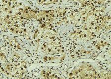 FOXO1 / FKHR Antibody - 1:100 staining human breast carcinoma tissue by IHC-P. The sample was formaldehyde fixed and a heat mediated antigen retrieval step in citrate buffer was performed. The sample was then blocked and incubated with the antibody for 1.5 hours at 22°C. An HRP conjugated goat anti-rabbit antibody was used as the secondary.