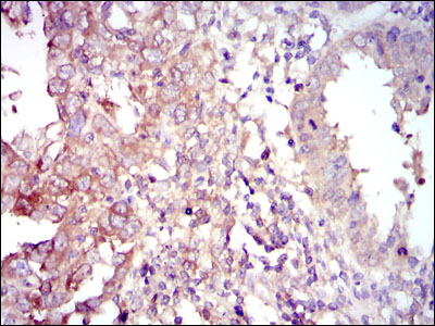 FOXO1 / FKHR Antibody - IHC of paraffin-embedded intima cancer tissues using FOXO1 mouse monoclonal antibody with DAB staining.
