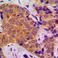 FOXO1 / FKHR Antibody - Immunohistochemical analysis of FOXO1 staining in human breast cancer formalin fixed paraffin embedded tissue section. The section was pre-treated using heat mediated antigen retrieval with sodium citrate buffer (pH 6.0). The section was then incubated with the antibody at room temperature and detected using an HRP conjugated compact polymer system. DAB was used as the chromogen. The section was then counterstained with hematoxylin and mounted with DPX.
