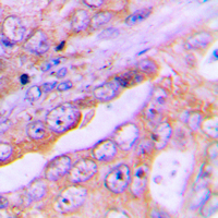 FOXO1 / FKHR Antibody - Immunohistochemical analysis of FOXO1 staining in human lung cancer formalin fixed paraffin embedded tissue section. The section was pre-treated using heat mediated antigen retrieval with sodium citrate buffer (pH 6.0). The section was then incubated with the antibody at room temperature and detected using an HRP conjugated compact polymer system. DAB was used as the chromogen. The section was then counterstained with hematoxylin and mounted with DPX.