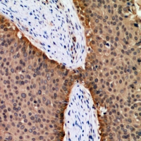FOXO1 / FKHR Antibody - Immunohistochemical analysis of FOXO1 staining in human breast cancer formalin fixed paraffin embedded tissue section. The section was pre-treated using heat mediated antigen retrieval with sodium citrate buffer (pH 6.0). The section was then incubated with the antibody at room temperature and detected using an HRP conjugated compact polymer system. DAB was used as the chromogen. The section was then counterstained with haematoxylin and mounted with DPX.