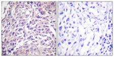 FOXO1 / FKHR Antibody - Peptide - + Immunohistochemistry analysis of paraffin-embedded human breast carcinoma tissue using FOXO1A (Ab-329) antibody.