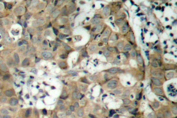 FOXO1 / FKHR Antibody - IHC of FoxO1 (F313) pAb in paraffin-embedded human breast carcinoma tissue.
