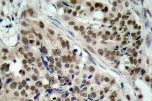 FOXO1 / FKHR Antibody - IHC of p-FoxO1 (S256) pAb in paraffin-embedded human breast carcinoma tissue.