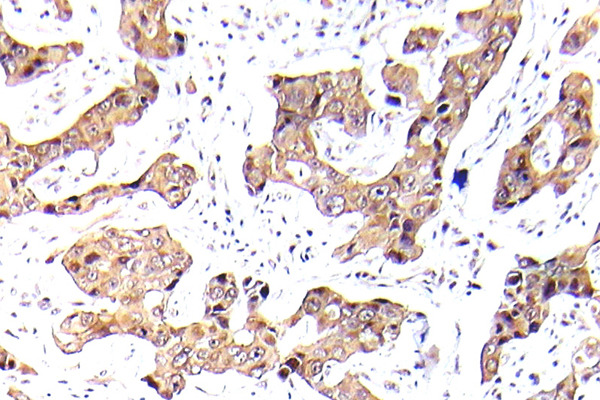 FOXO1 / FKHR Antibody - IHC of p-FKHR/FOXO1A (S256)pAb in paraffin-embedded human breast carcinoma tissue.