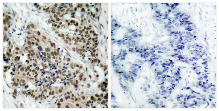 FOXO1 / FKHR Antibody - Immunohistochemistry analysis of paraffin-embedded human breast carcinoma, using FKHR (Phospho-Ser256) Antibody. The picture on the right is blocked with the phospho peptide.