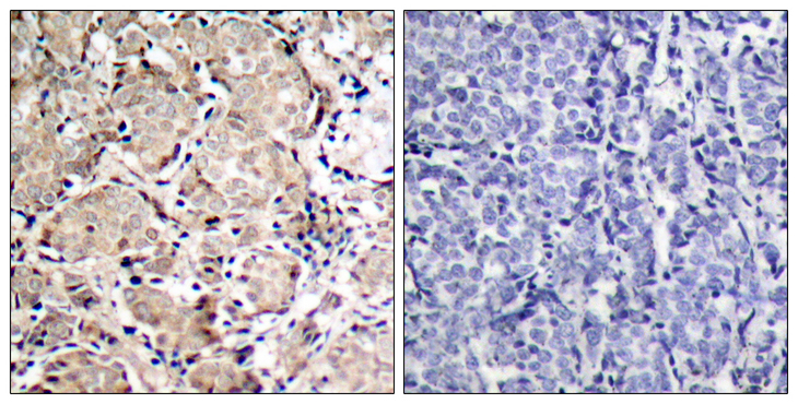 FOXO1 / FKHR Antibody - Immunohistochemistry analysis of paraffin-embedded human breast carcinoma, using FKHR (Phospho-Ser319) Antibody. The picture on the right is blocked with the phospho peptide.